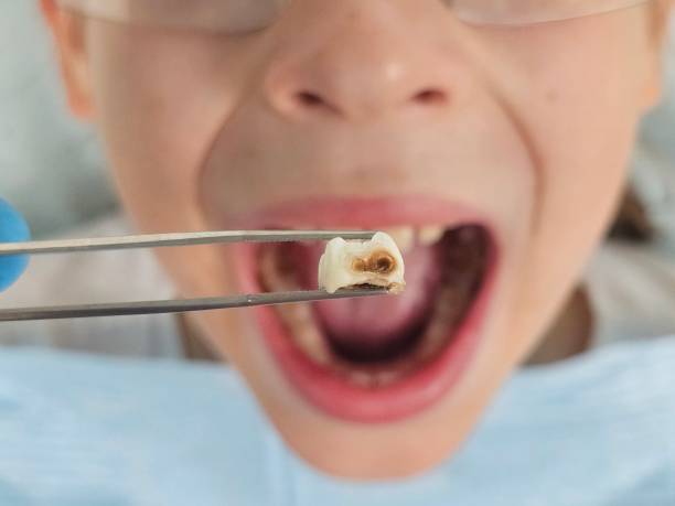 Best Emergency Treatment for Toothache in Mount Carmel, PA